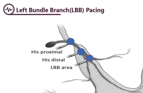 LBB Pacing